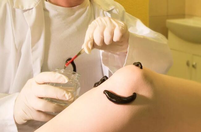 Hirudotherapy for varicose veins