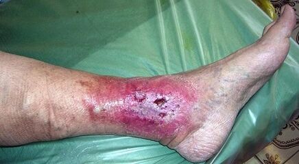 Varicosis complications for vessels