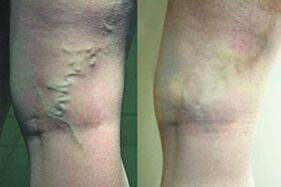Varicosis veins in the legs