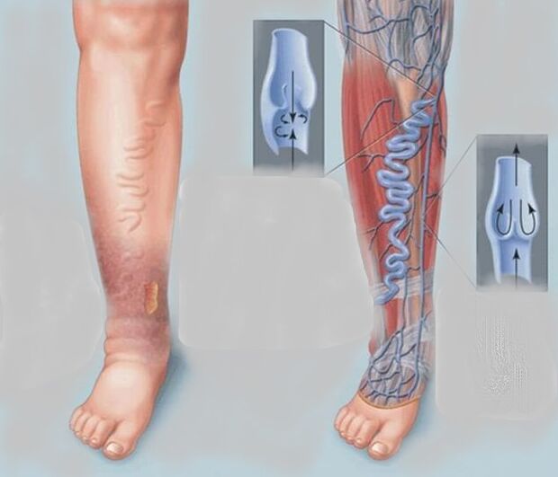 Varicosis veins in the legs