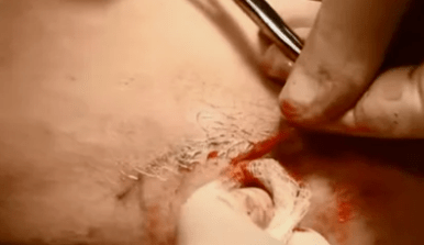 Types of operations to remove varicose veins