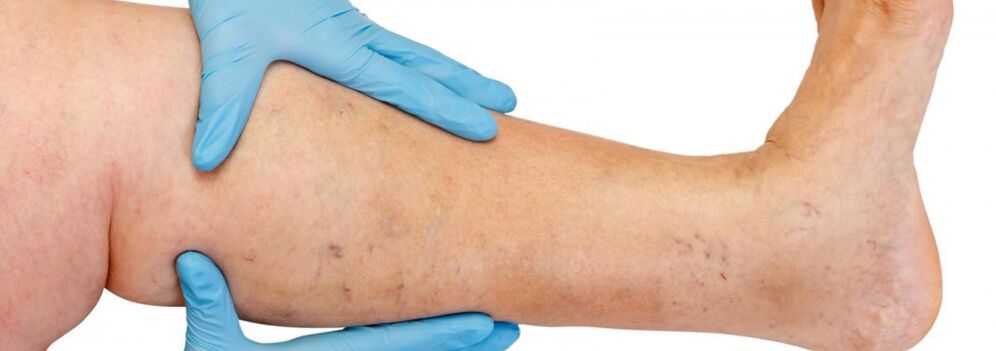Varicose veins in the legs