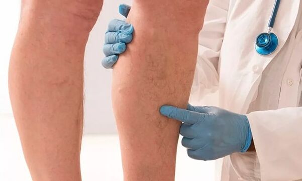 the doctor examines the legs for varicose veins